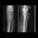 Bladder carcinoma, bone metastasis: X-ray - Plain radiograph